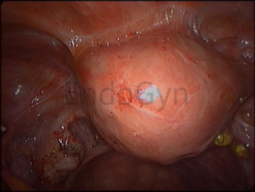 Adhesions after C-Section-05