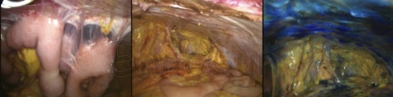 adhesiolysis-01